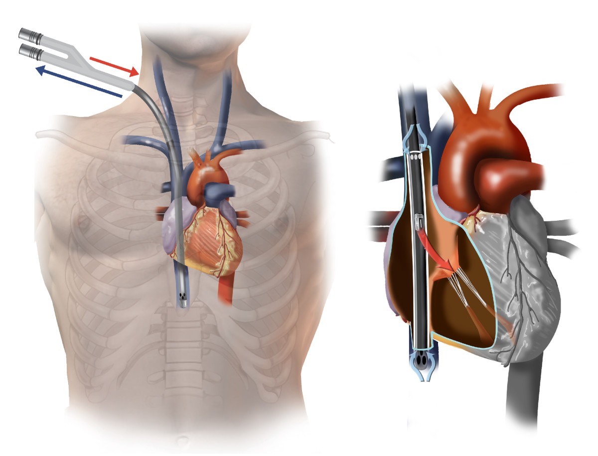 Echo-guided bi-caval dual lumen ECMO catheter insertion (Avalon Elite ...