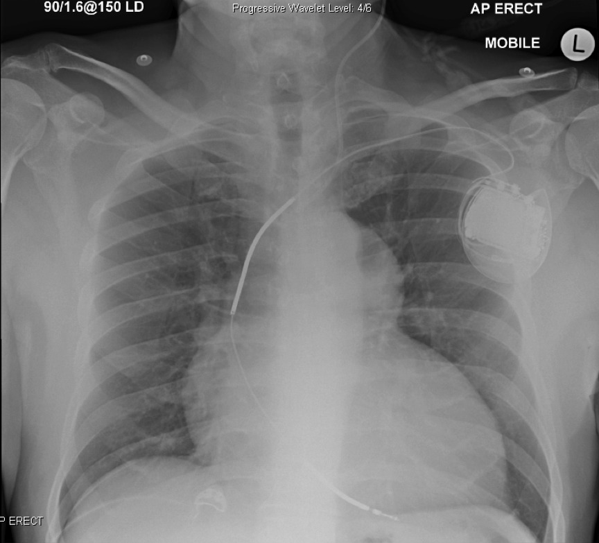 A Chest Radiograph after Cardiac Surgery INTENSIVE