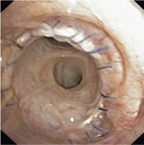 lung bronchial anastomosis