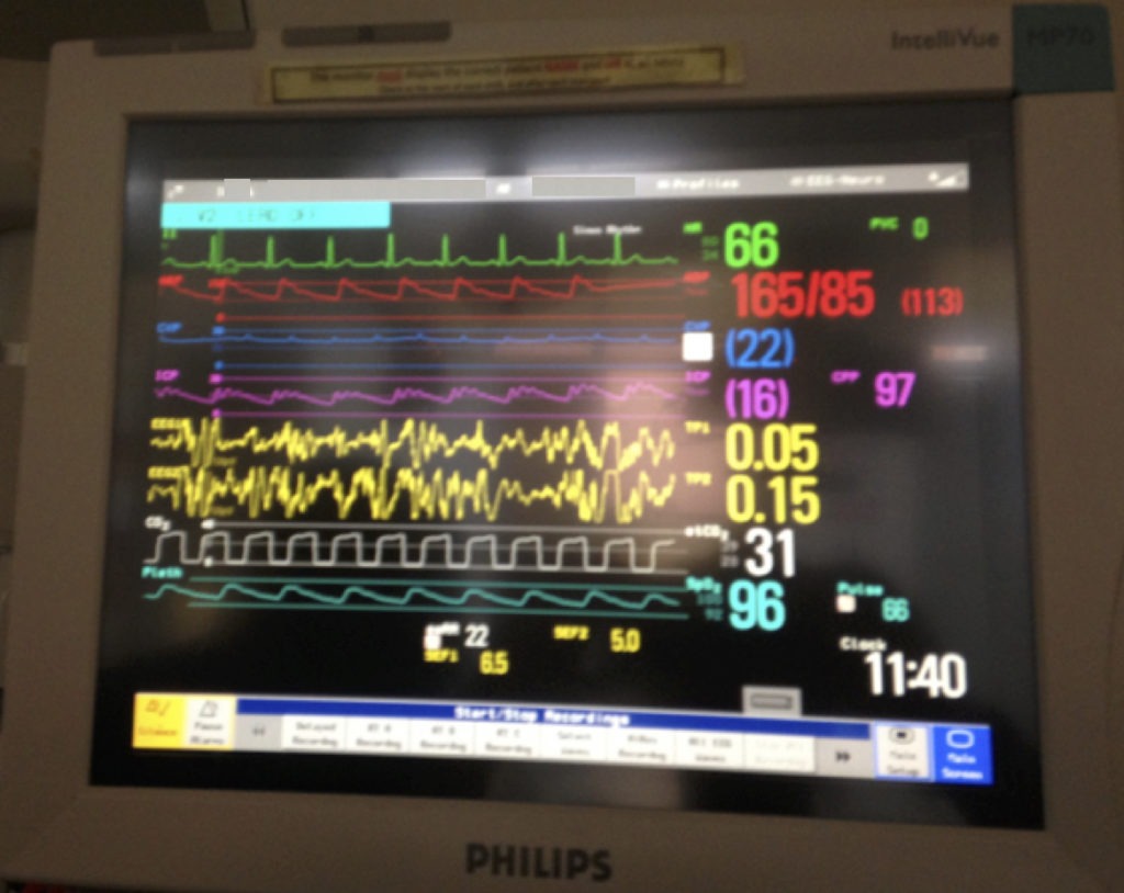 A case of TBI monitor