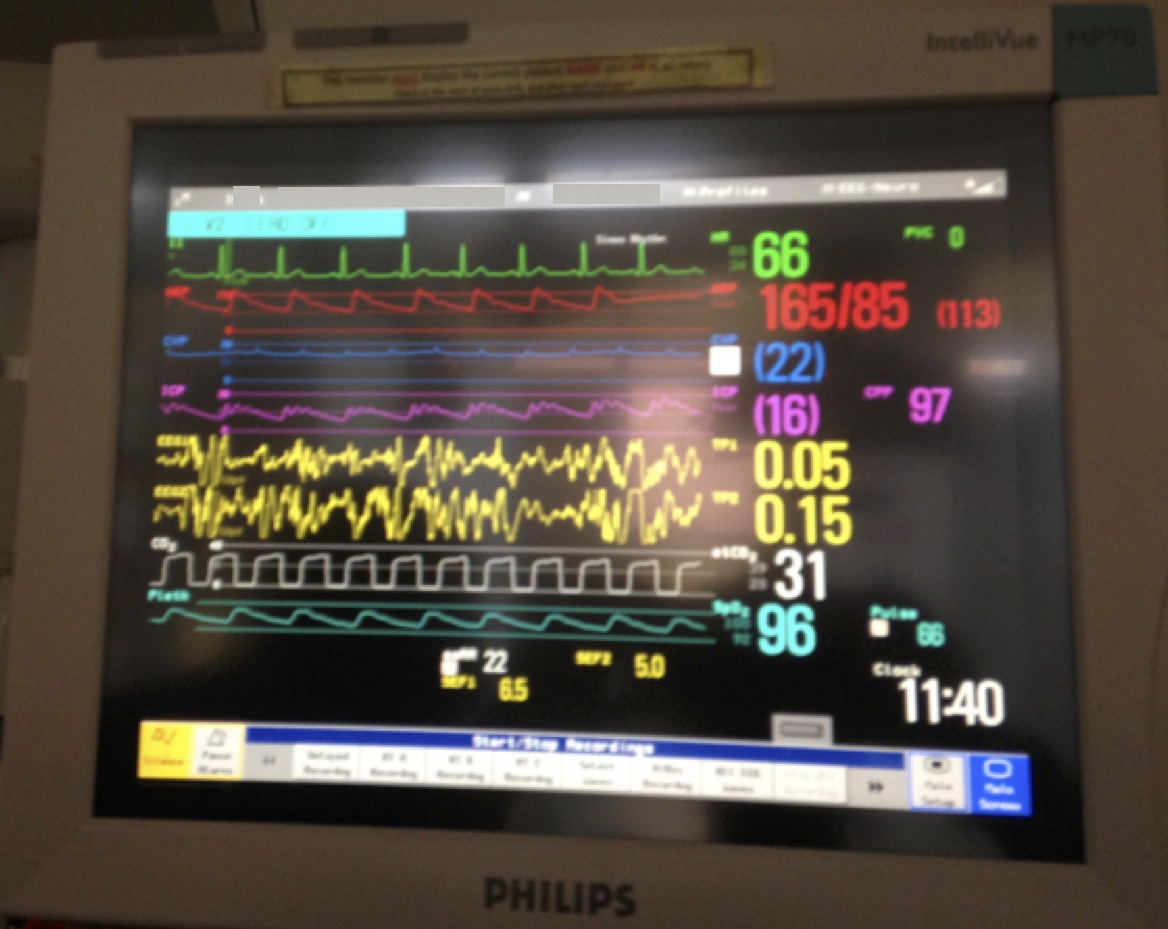 Icu Monitor Normal Range at Albert Black blog