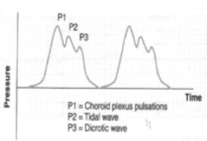 ICP waveform P123