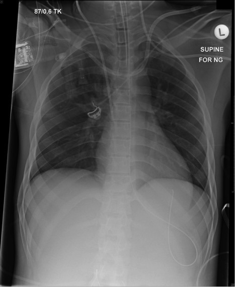 Confirming Central Venous Access Position Chest X-Ray, 48% OFF