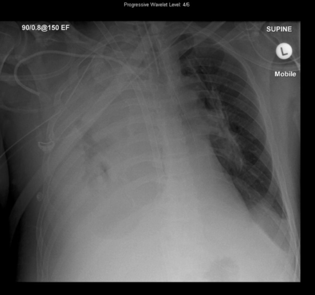 everything-ecmo-005-cxr