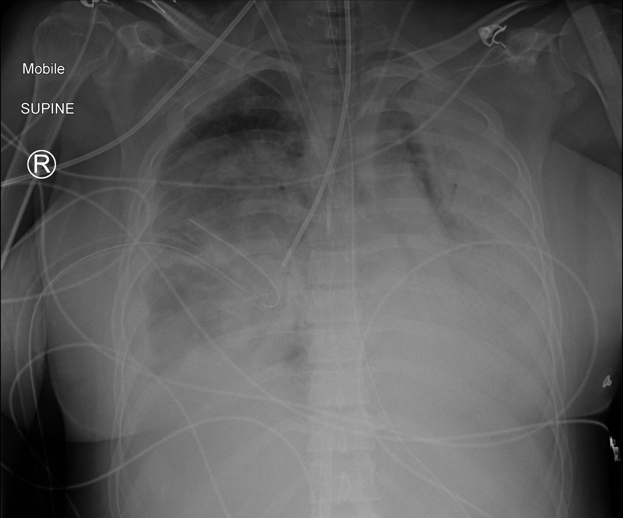 Bronchial BLocker CXR INTENSIVE