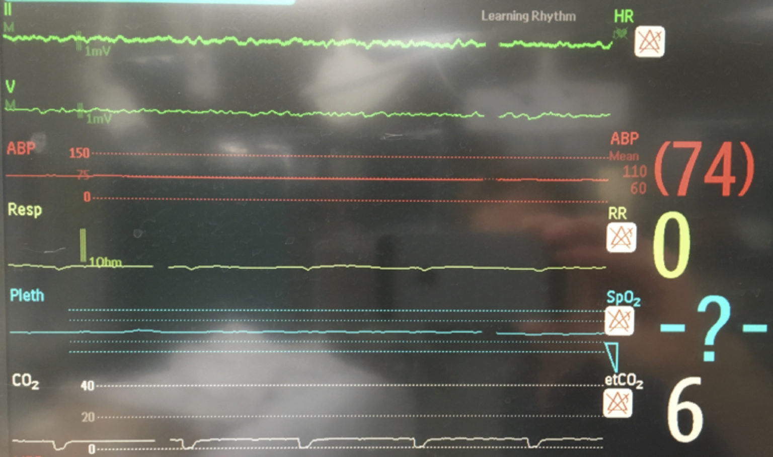 VF on VA ECMO monitor INTENSIVE