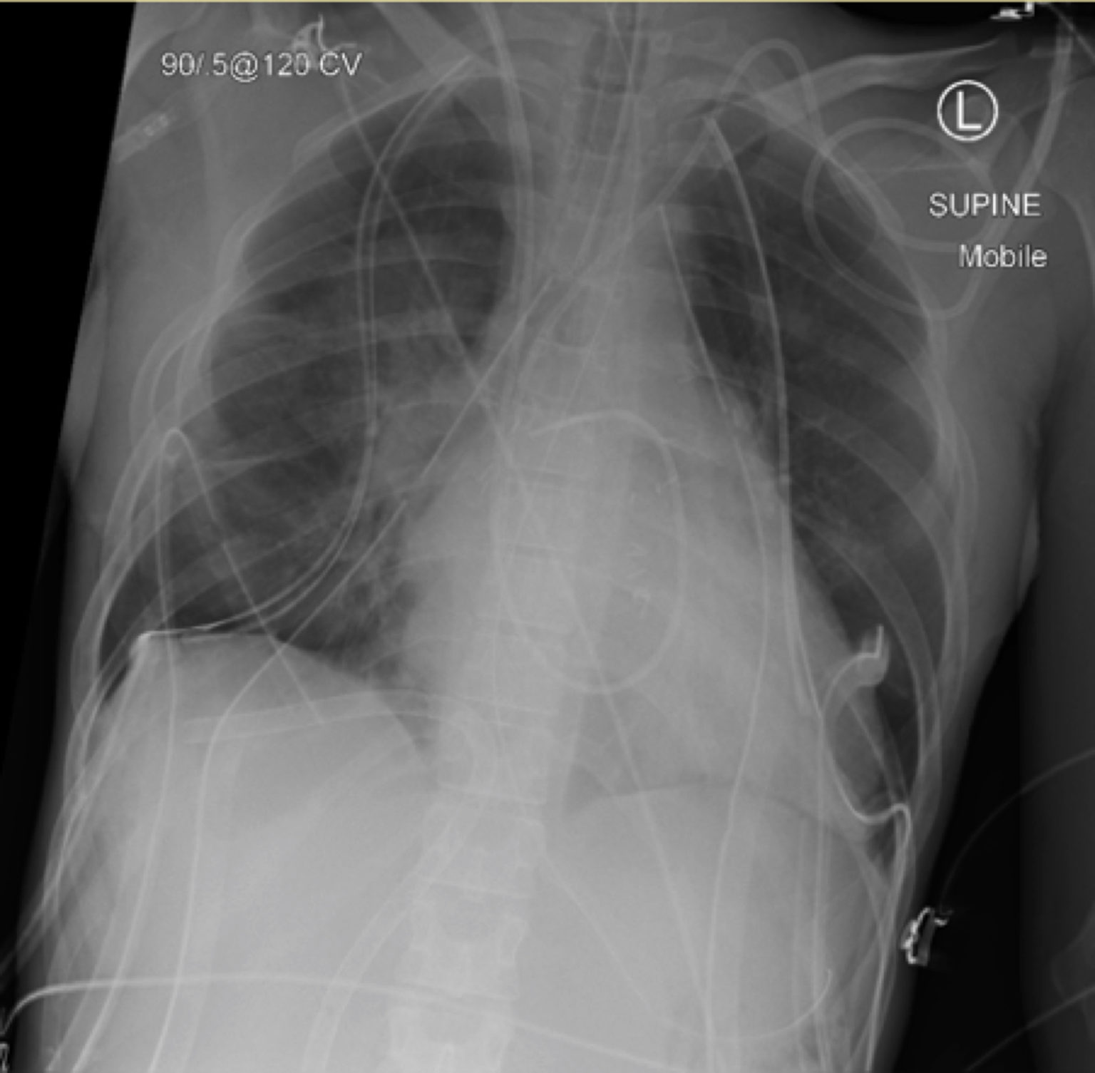 Everything ECMO: Cannula and Cardiac Curveballs - INTENSIVE