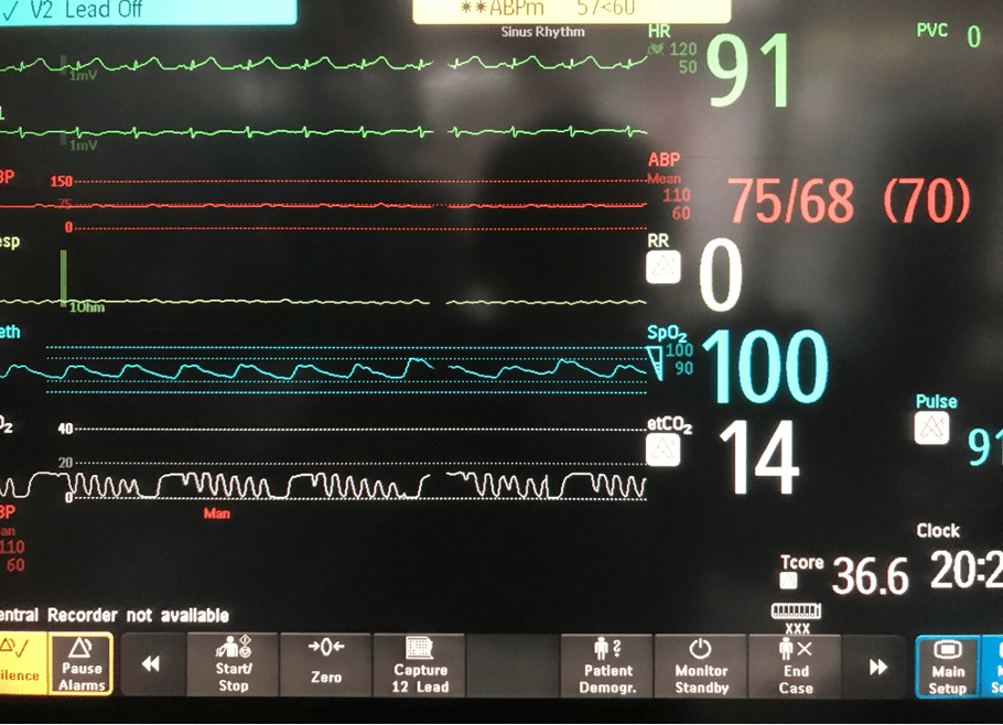 Wave balance BP Moniter